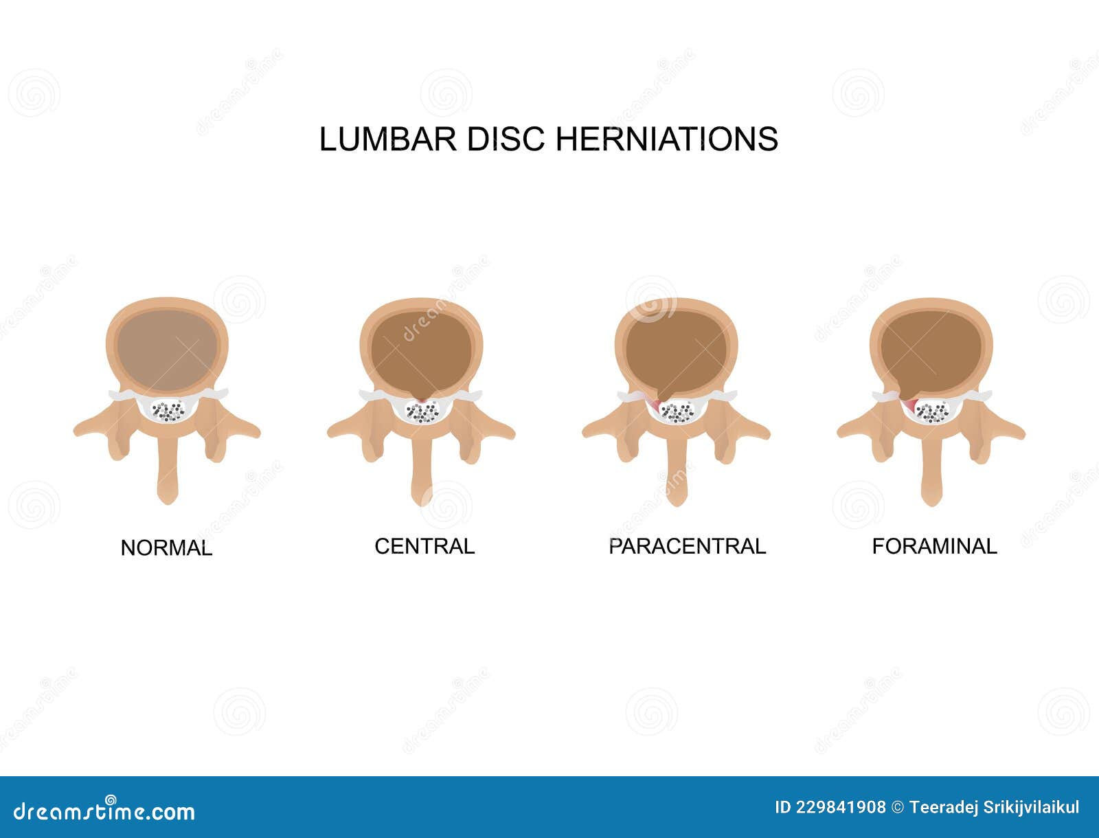 Type of Lumbar Disc Herniations Stock Vector Illustration of cross