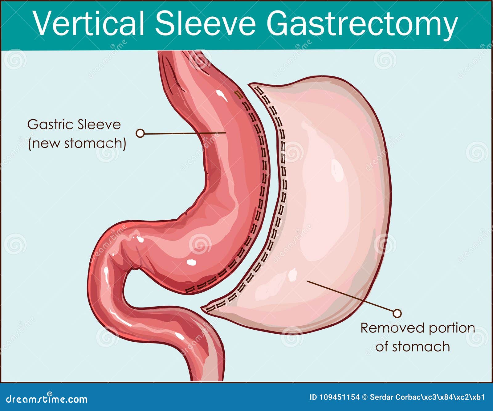 Vector Illustration of Vertical Sleeve Gastrectomy Stock Vector