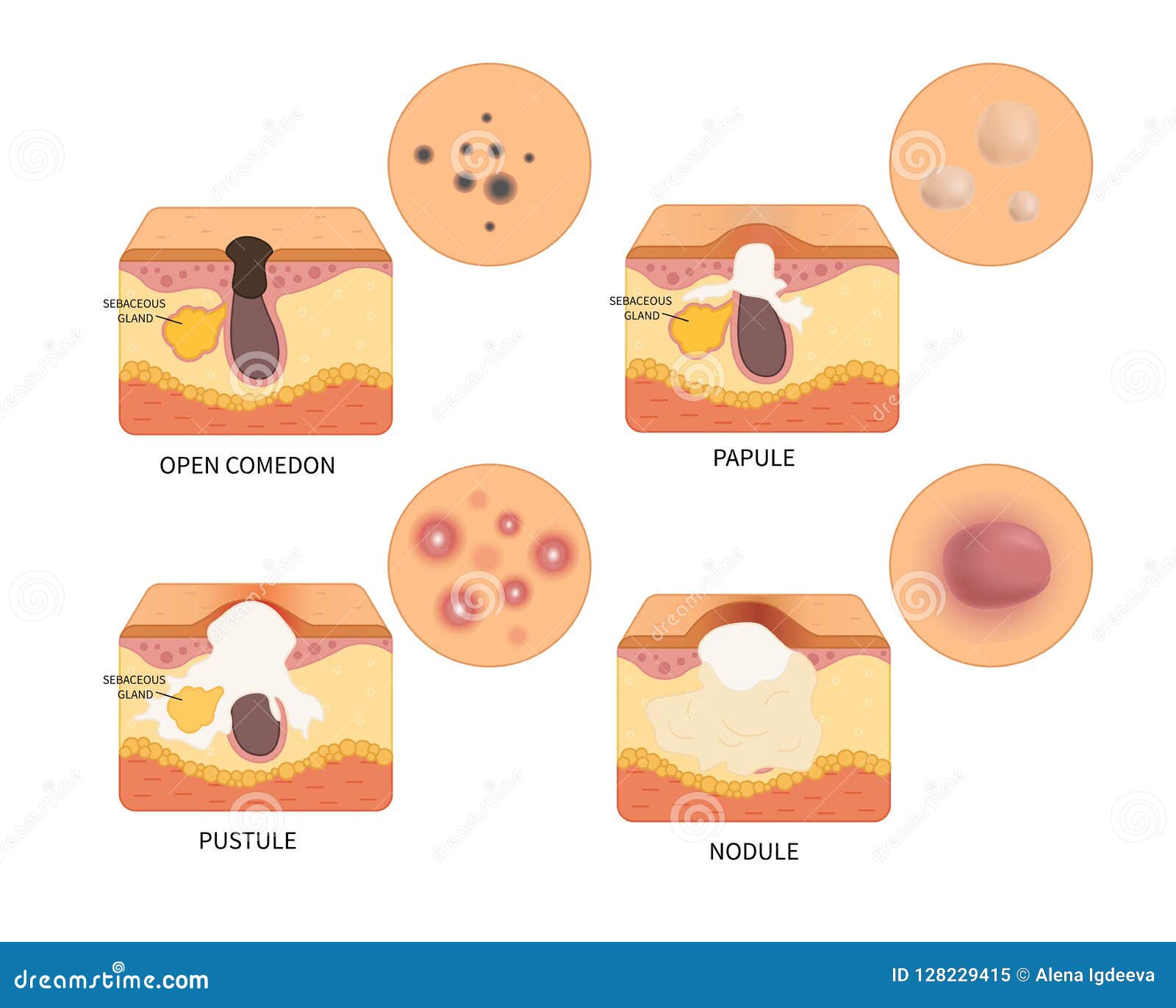 Vector types of acne stock vector. Illustration of medical - 128229415