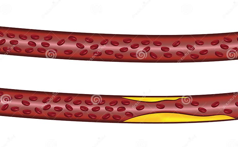 Veins Blood Vessels Normal Flow and Blocked Veins Blood Vessels Flow