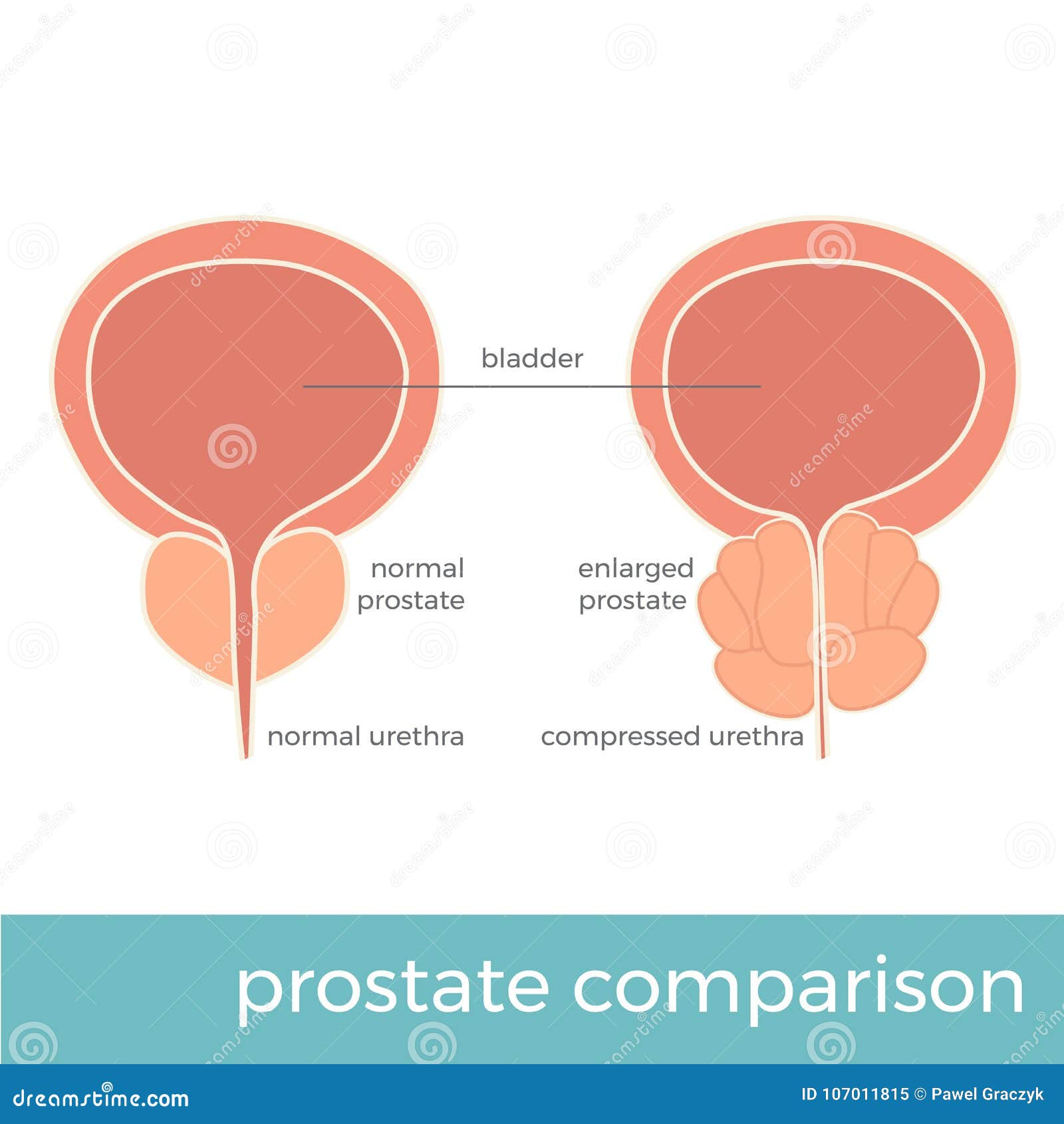 prostata normale größe la próstata