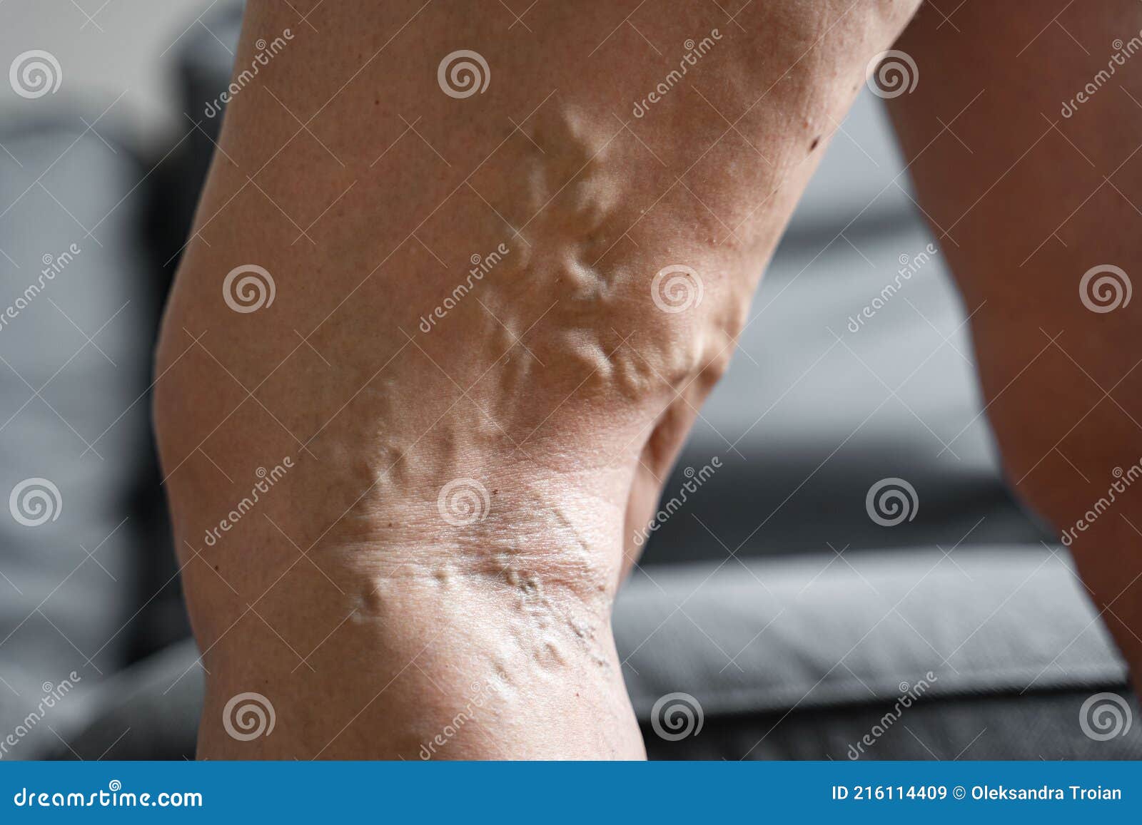perna de perna varicoza descrierea tratamentului cu varicoza