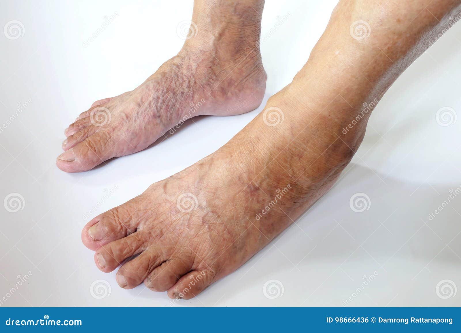 vene varicose piedi