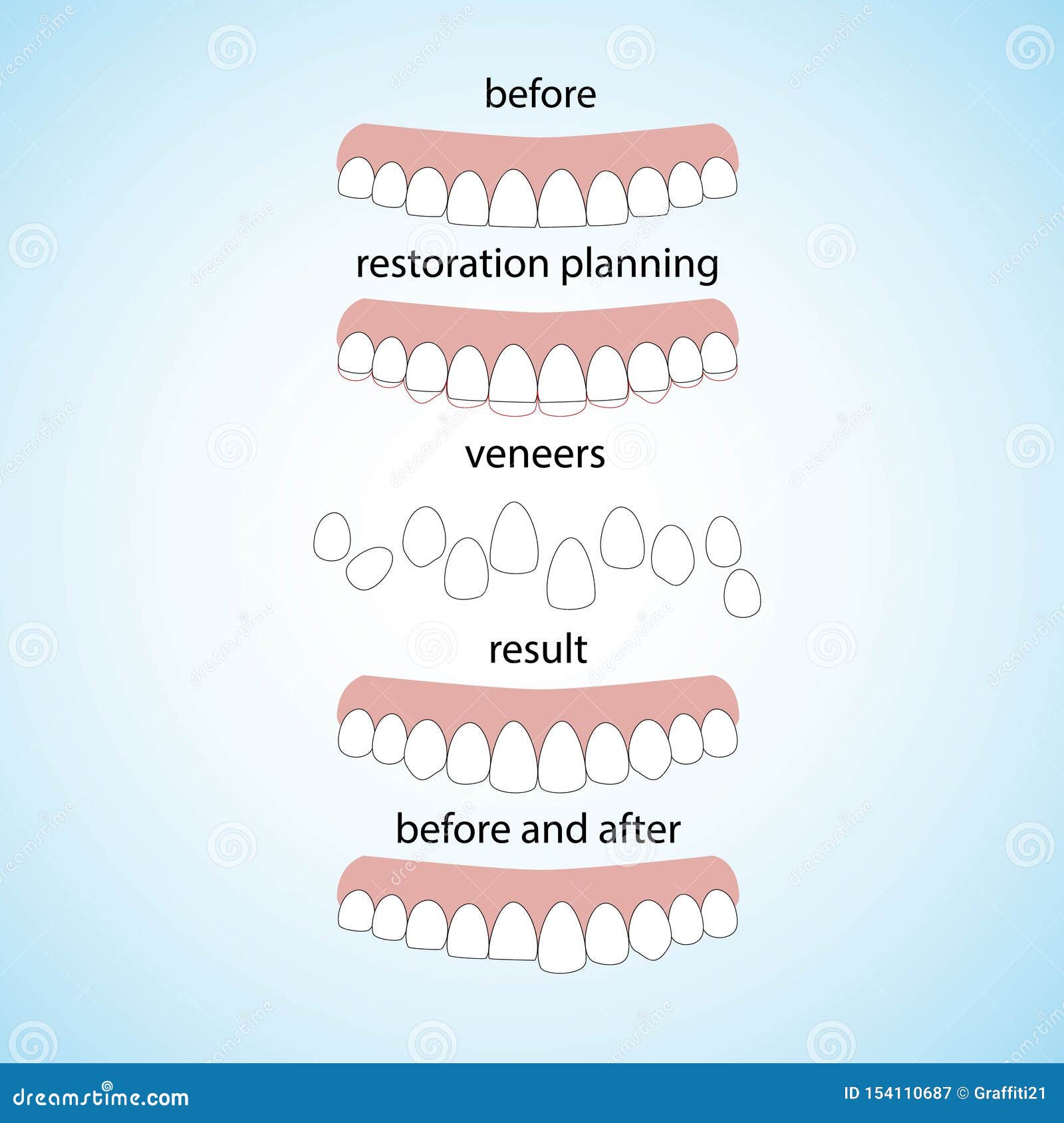 Veneers Dentistry, Great Design for Any Purposes. Stock Vector