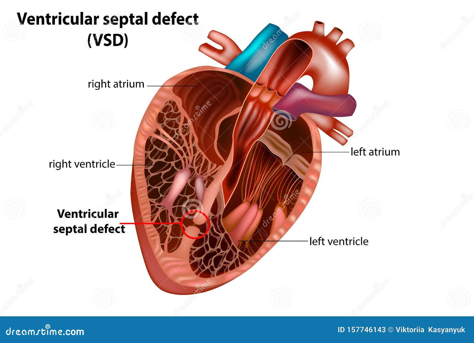 ventricular septal defect vsd