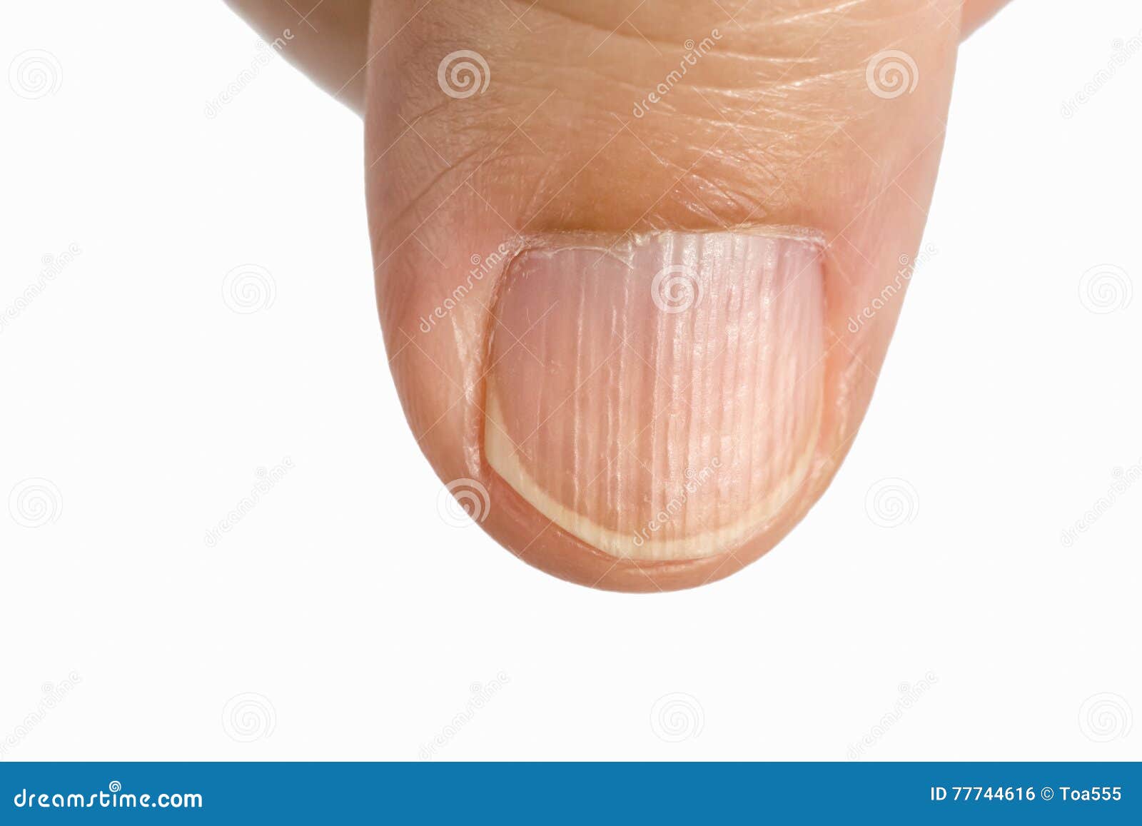 vertical ridges on the fingernails