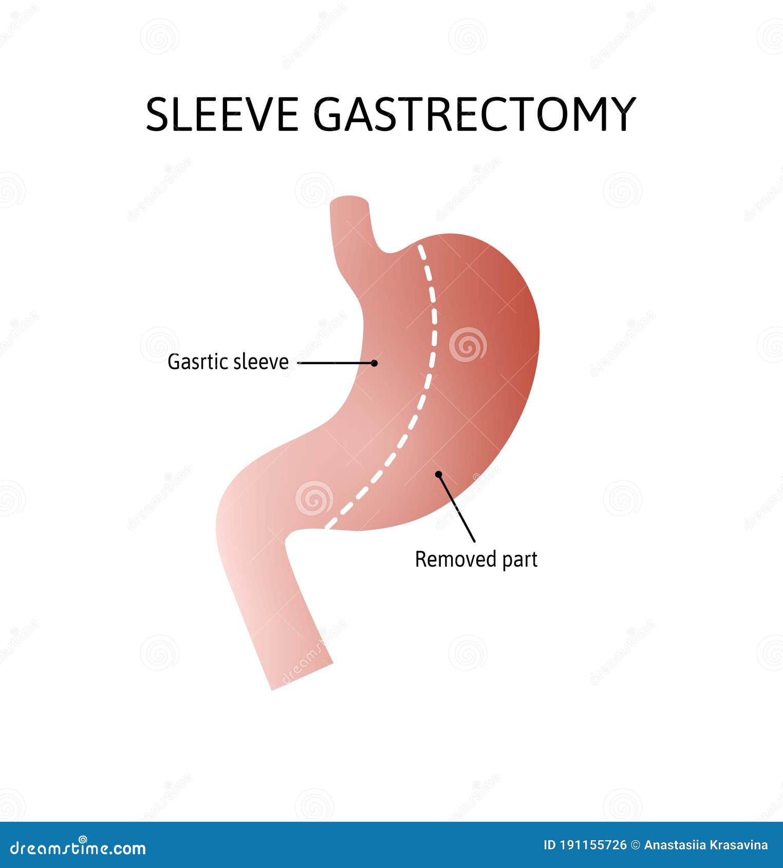 vertical sleeve gastrectomy. human stomach anatomy  on white background. decrease in stomach volume. 