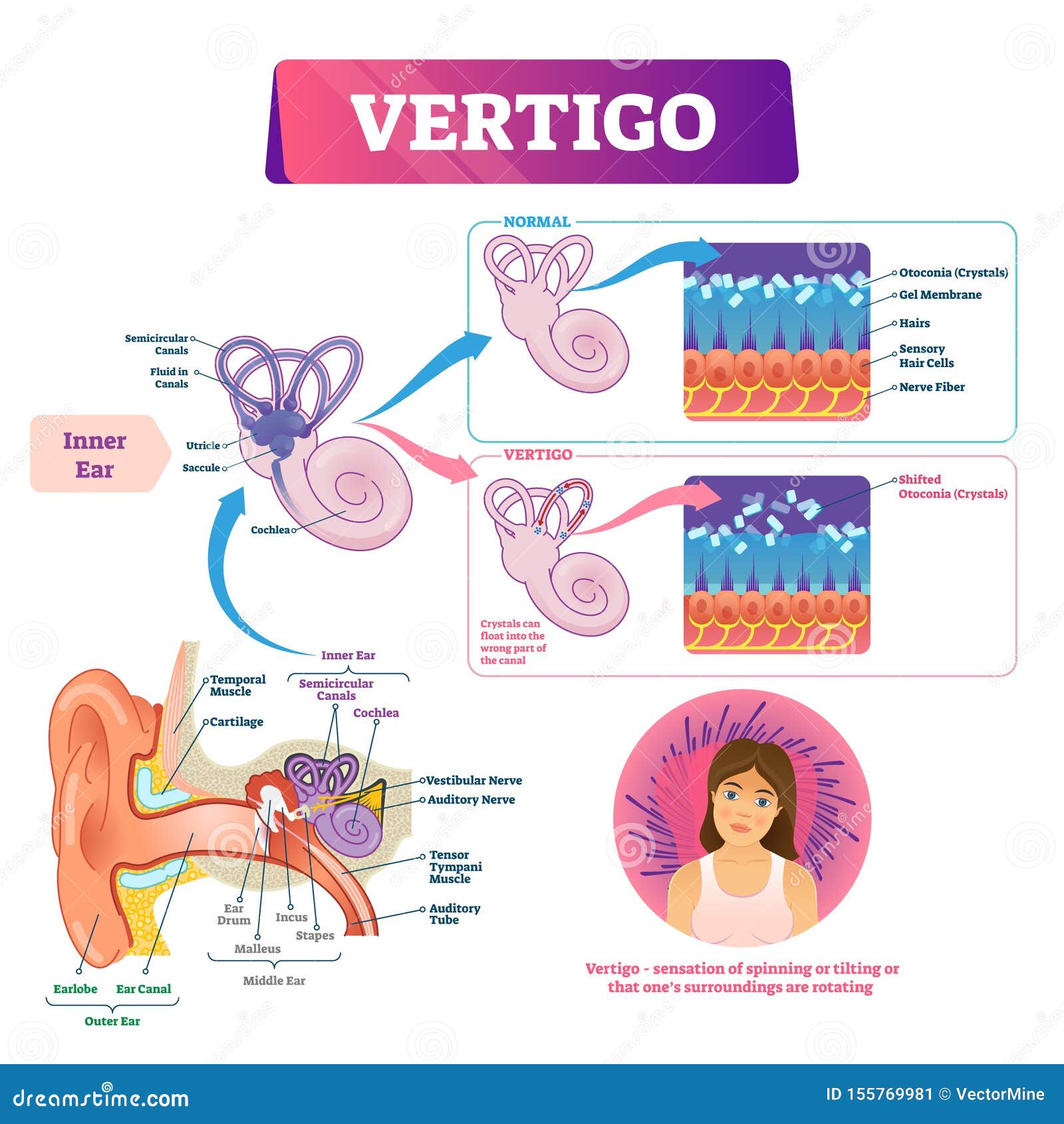 vertigo  . labeled medical vestibular ear problem scheme.