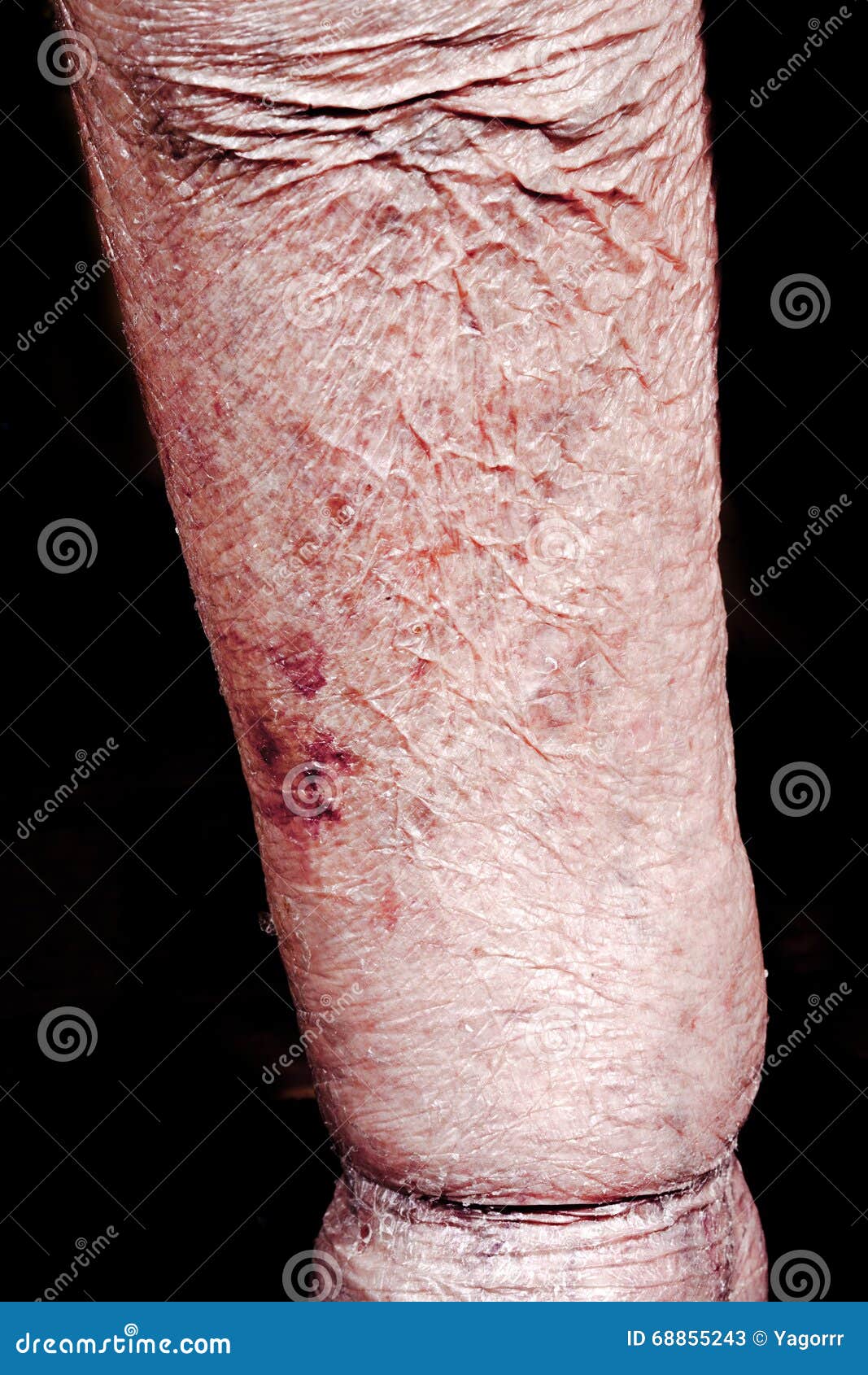 Viejo Hombre Enfermo De Shin, Grueso Imagen de archivo - Imagen de