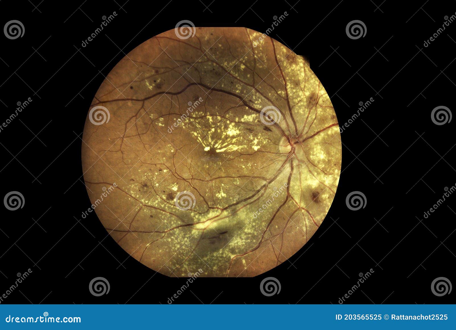 view inside human eye disorders showing retina, optic nerve and macula severe age-related macular degeneration