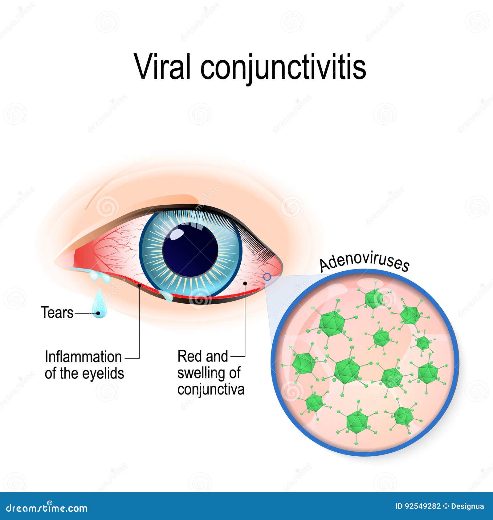 viral conjunctivitis