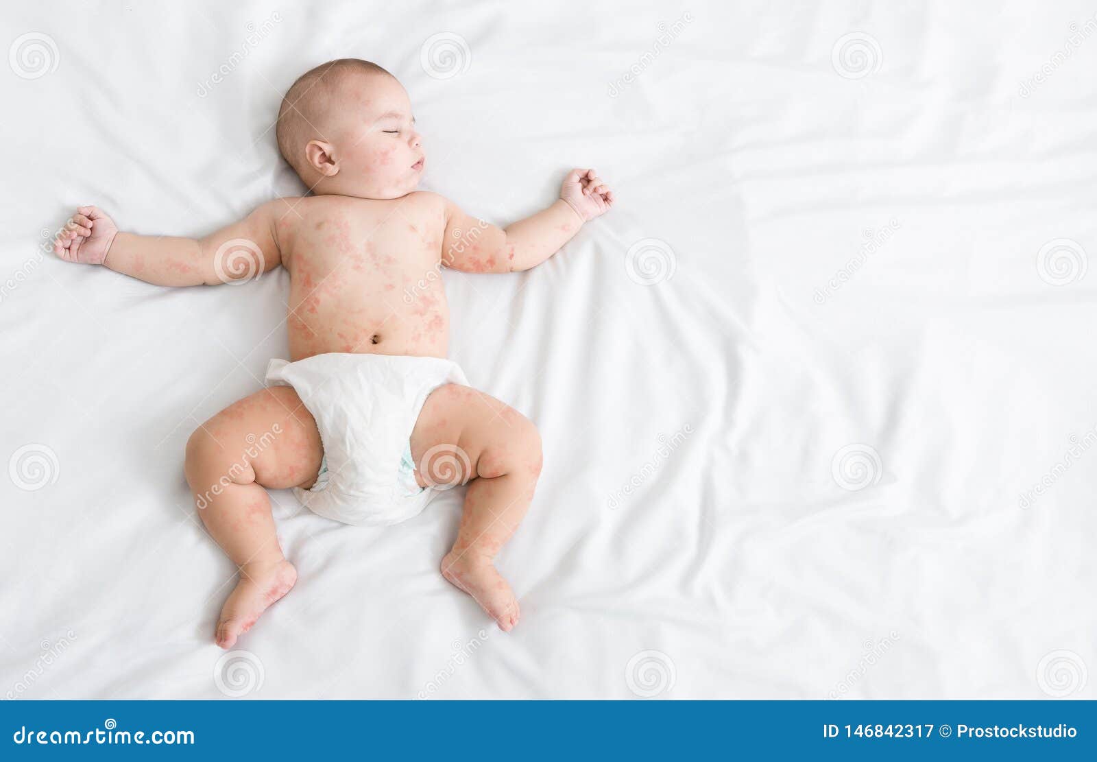 newborn baby with measles rash sleeping on bed