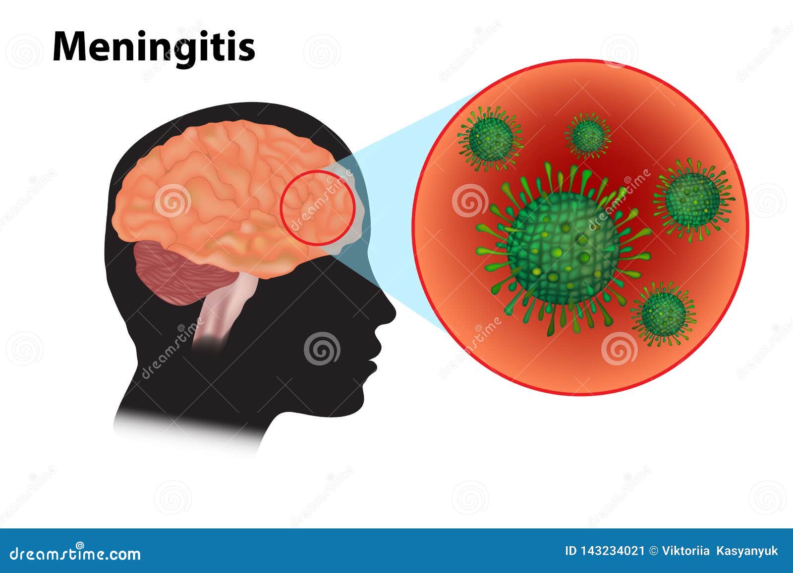 viral meningitis and encephalitis