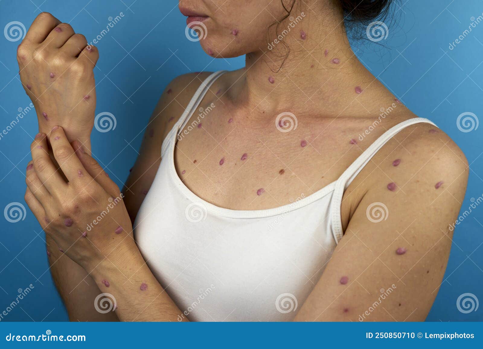 viral rash on woman& x27;s body because of monkeypox disease