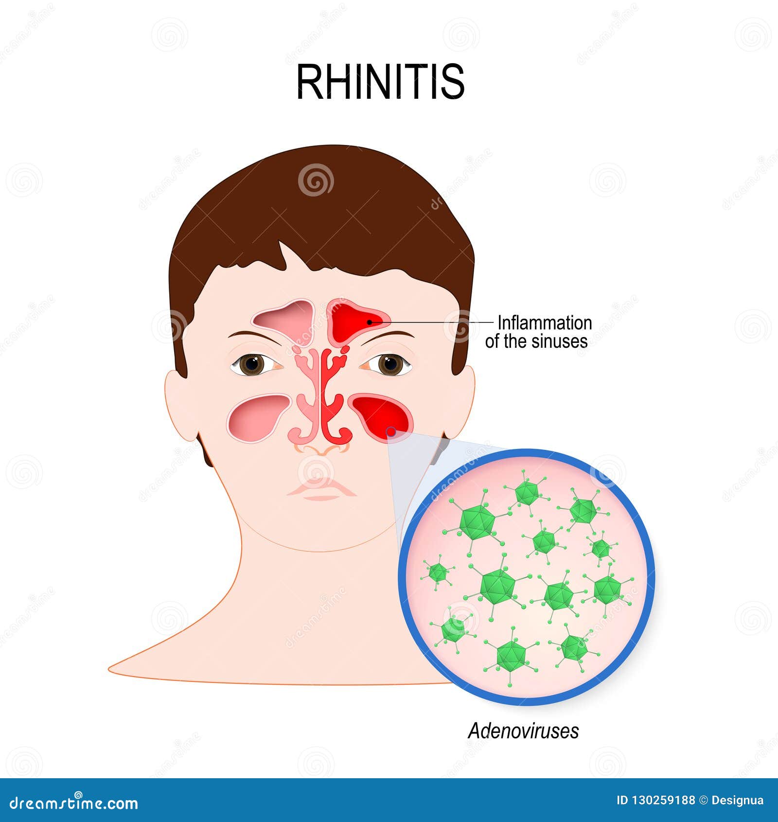 viral sinusitis rhinitis caused by adenovirus