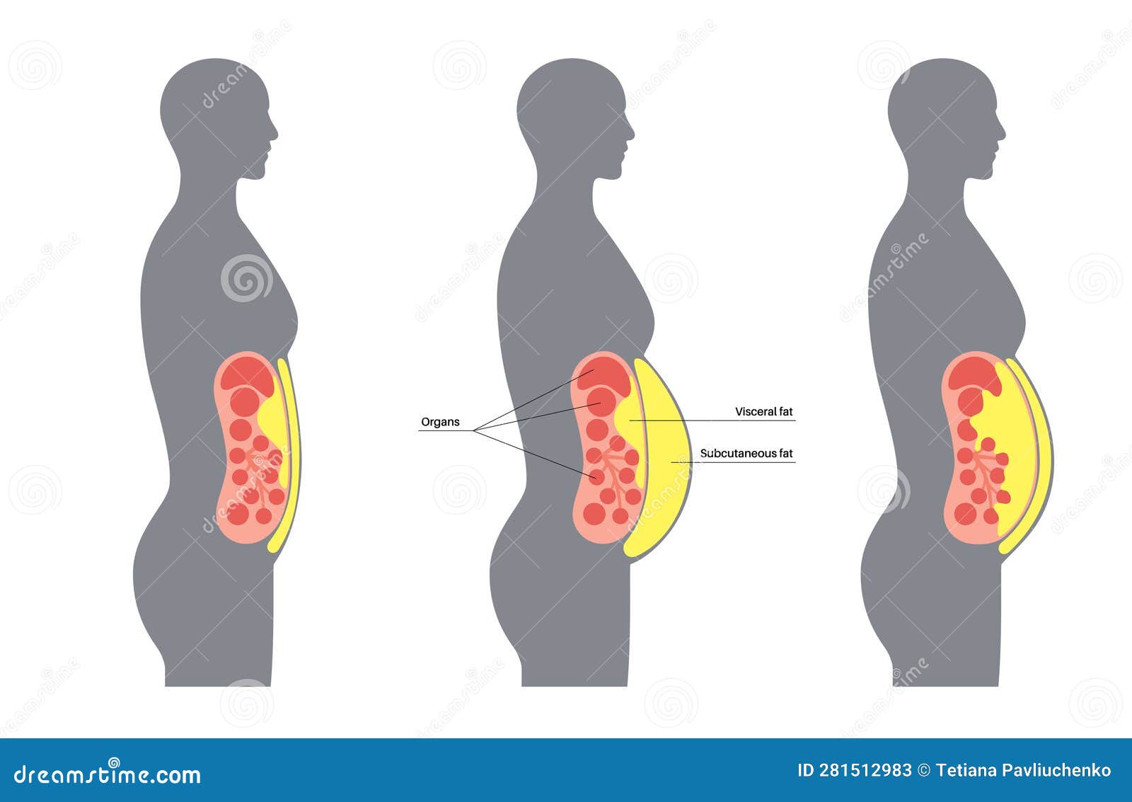 Visceral Fat Diagram Cartoon Vector | CartoonDealer.com #282102987