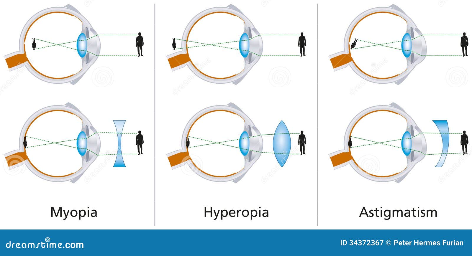 myopia, de hyperopia is)