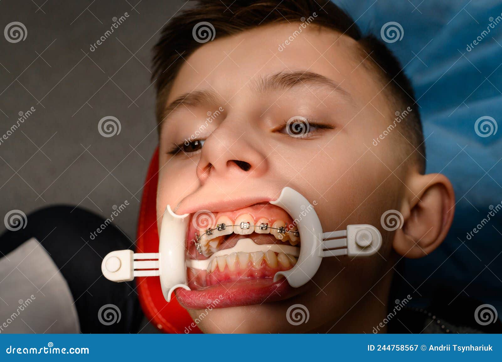 Visit To the Orthodontist, Installation of Braces on the Upper Teeth, White Retractor on the