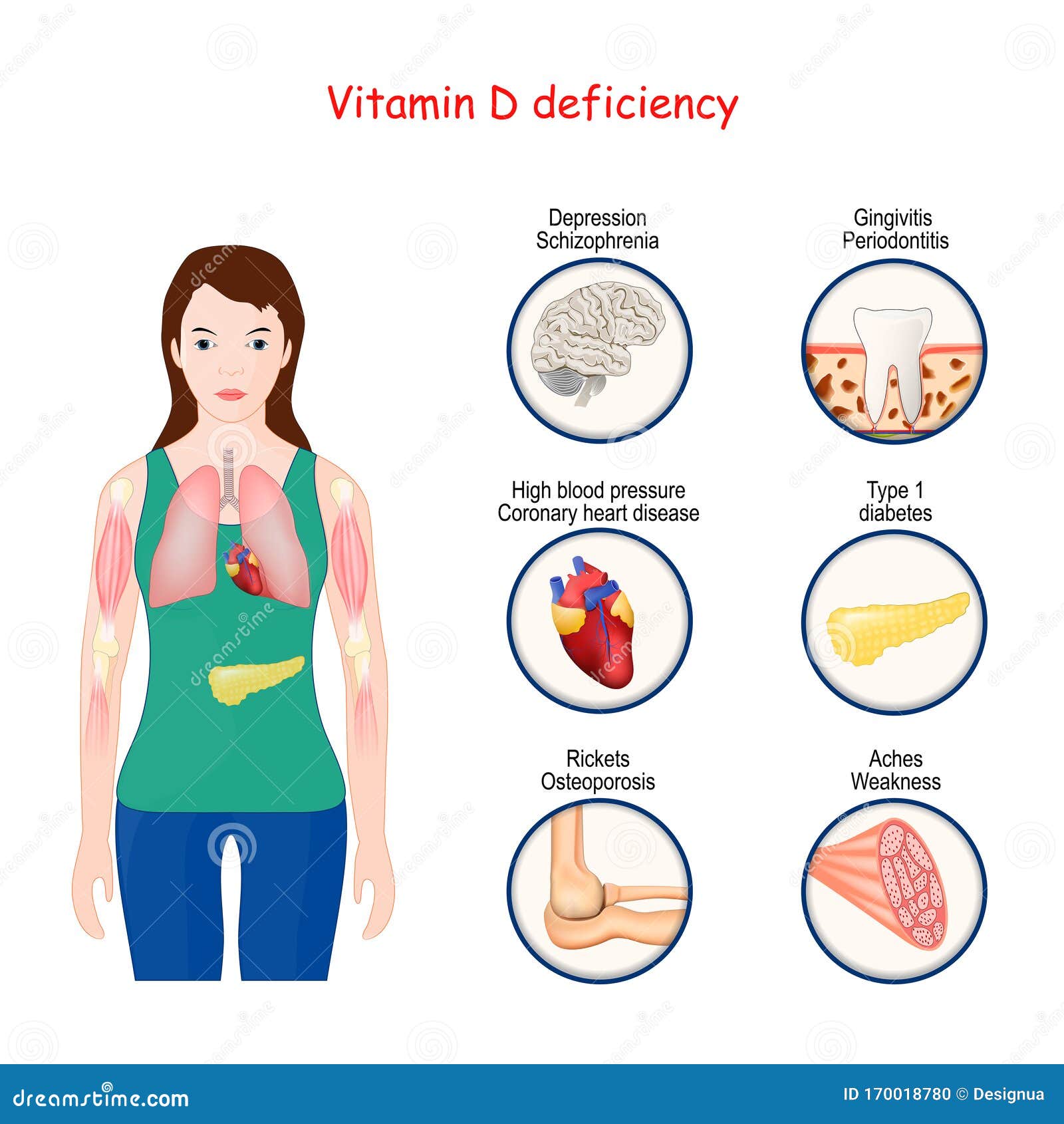 Vitamin D Deficiency. Human Body, and Close-up of Organs with Effects ...