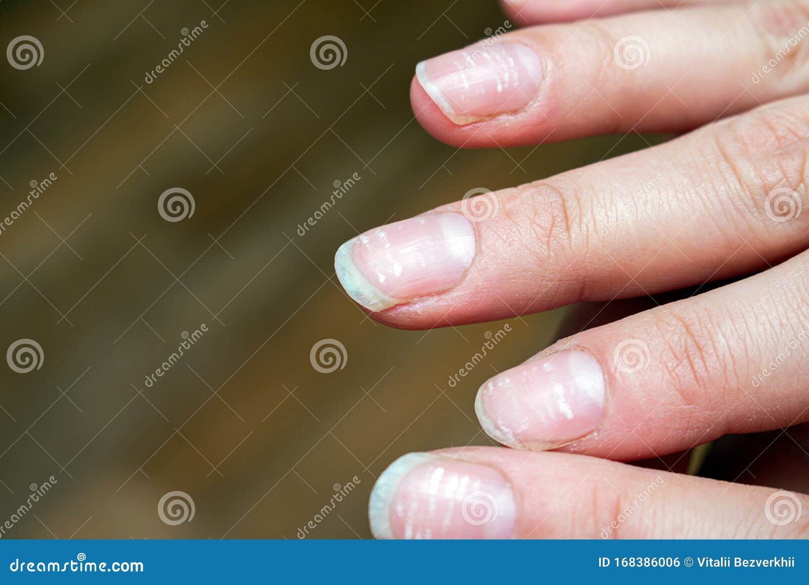 Vitamin Deficiency Finger Nail Stock Photos - Free & Royalty-Free Stock  Photos from Dreamstime