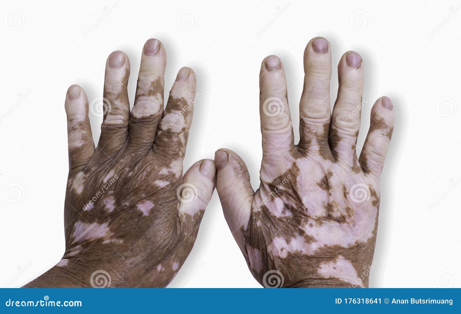 vitiligo disease on old hand.