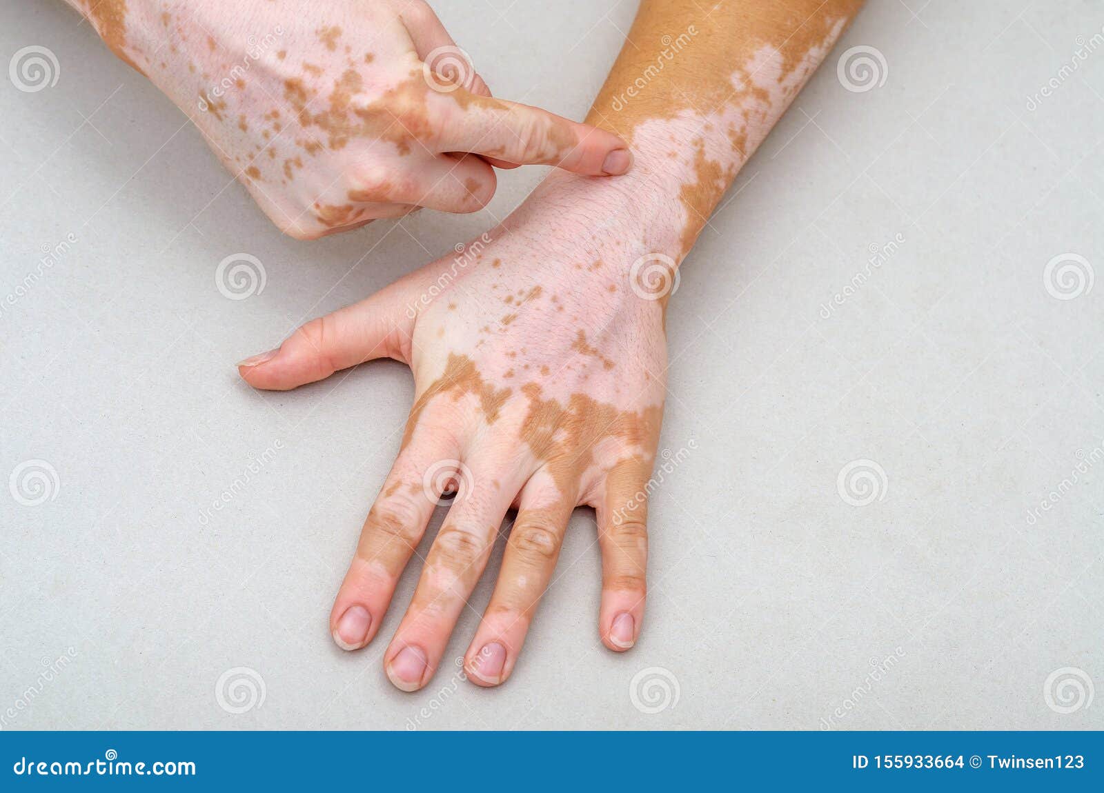 vitiligo on the skin of hands. finger indicates skin defect