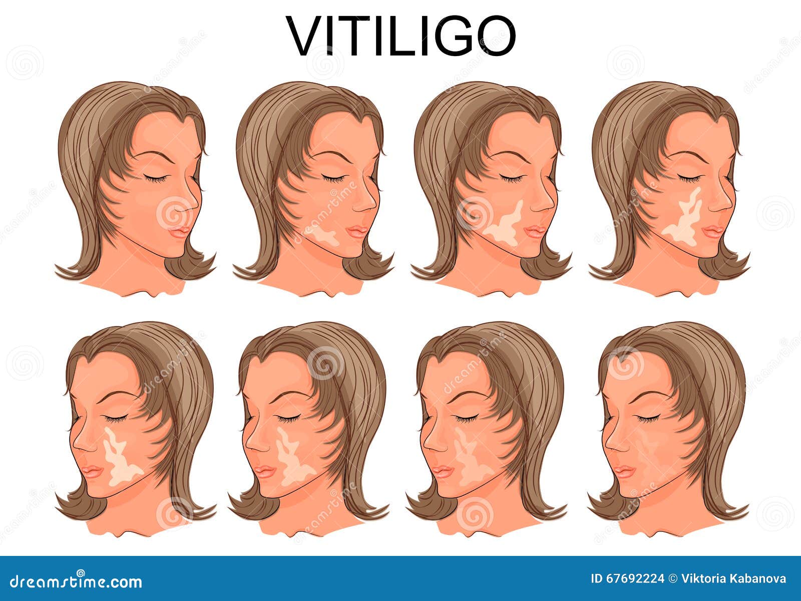 Vitiligo Treatment. Before And After Stock Vector - Image 