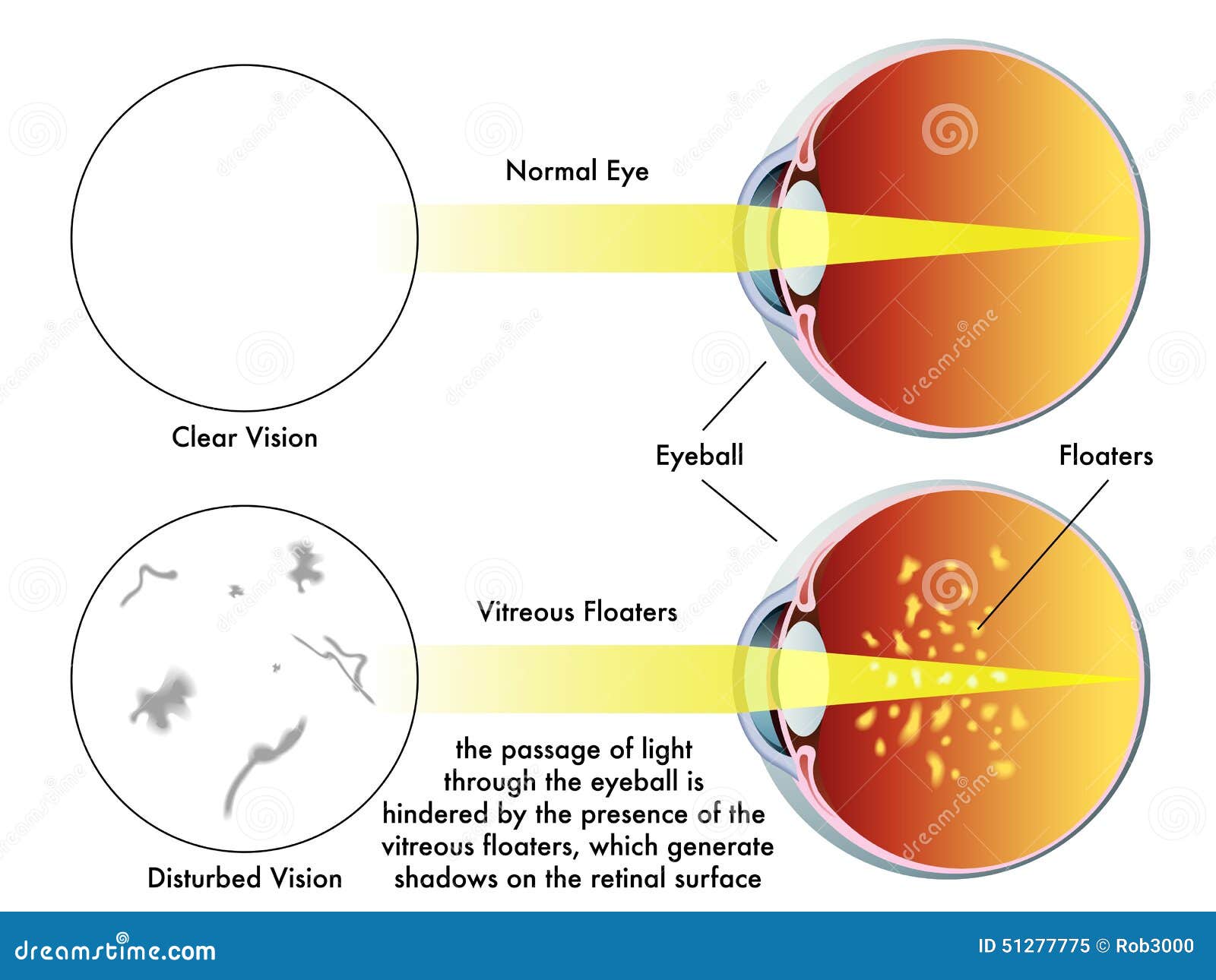 vitreous floaters