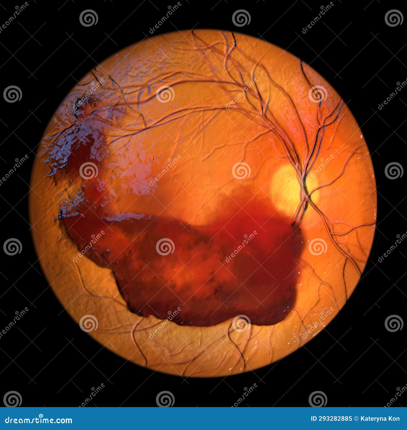 vitreous hemorrhage as observed during ophthalmoscopy, 3d 