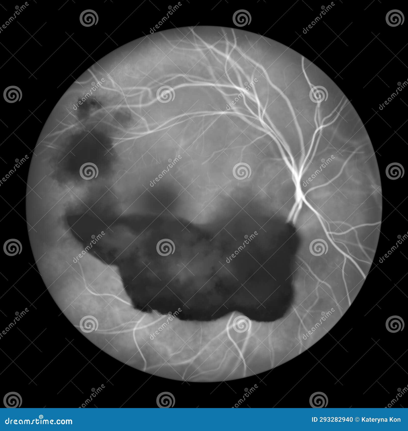 vitreous hemorrhage as observed during ophthalmoscopy, 