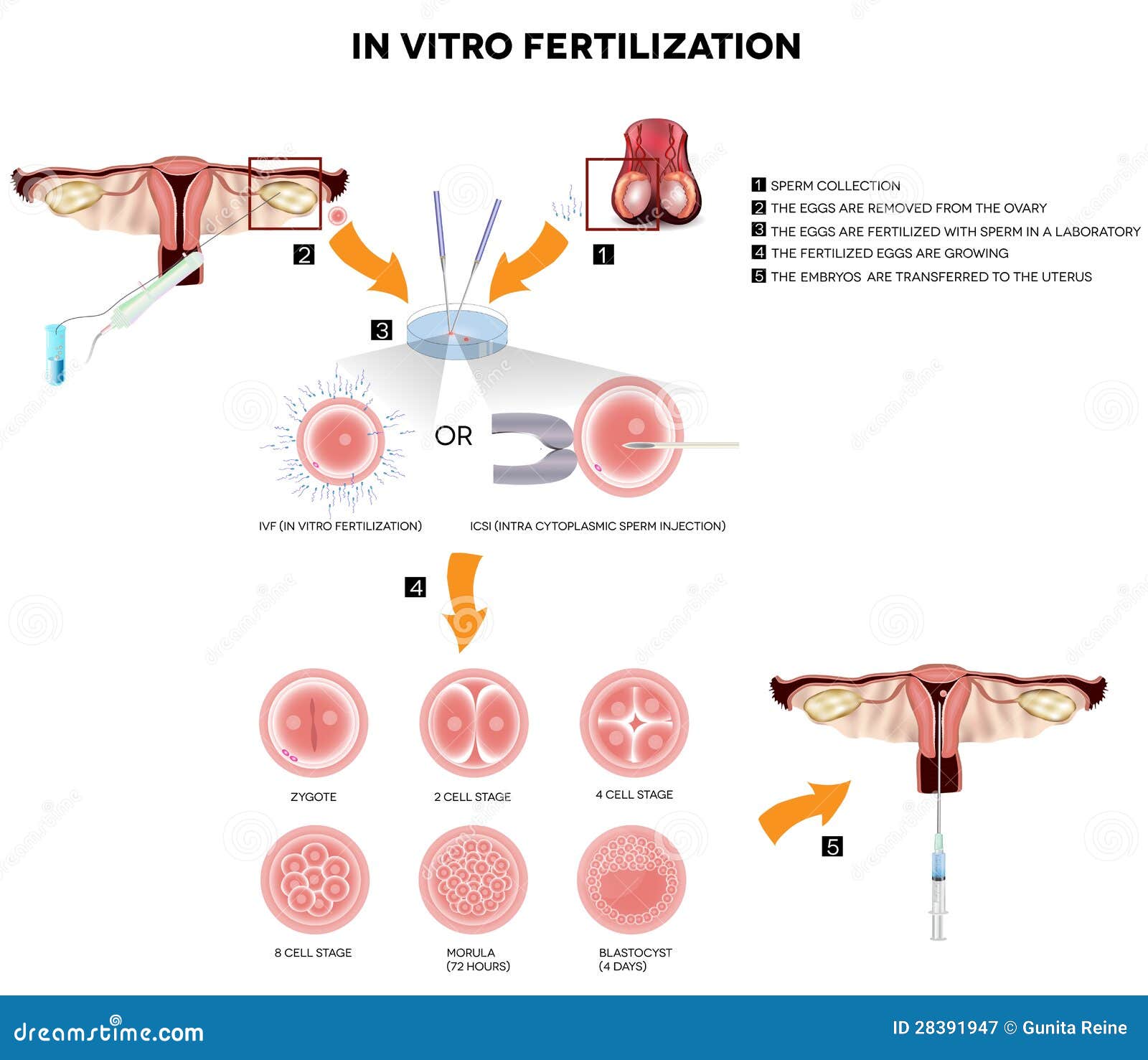 in vitro fertilization