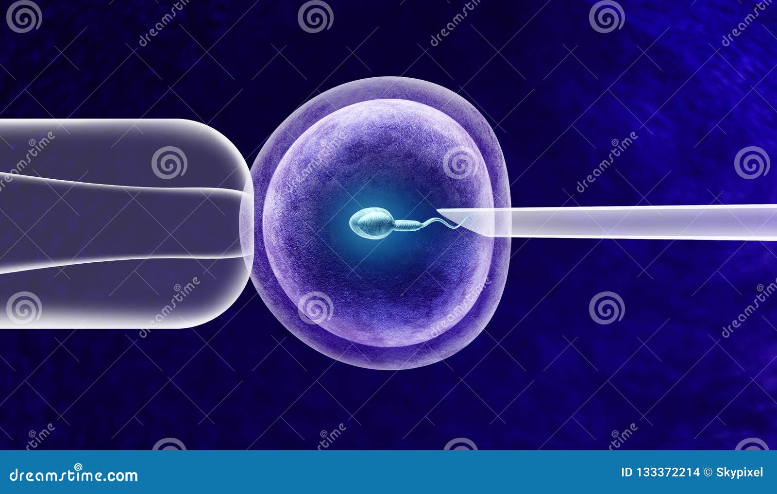 in vitro fertilization