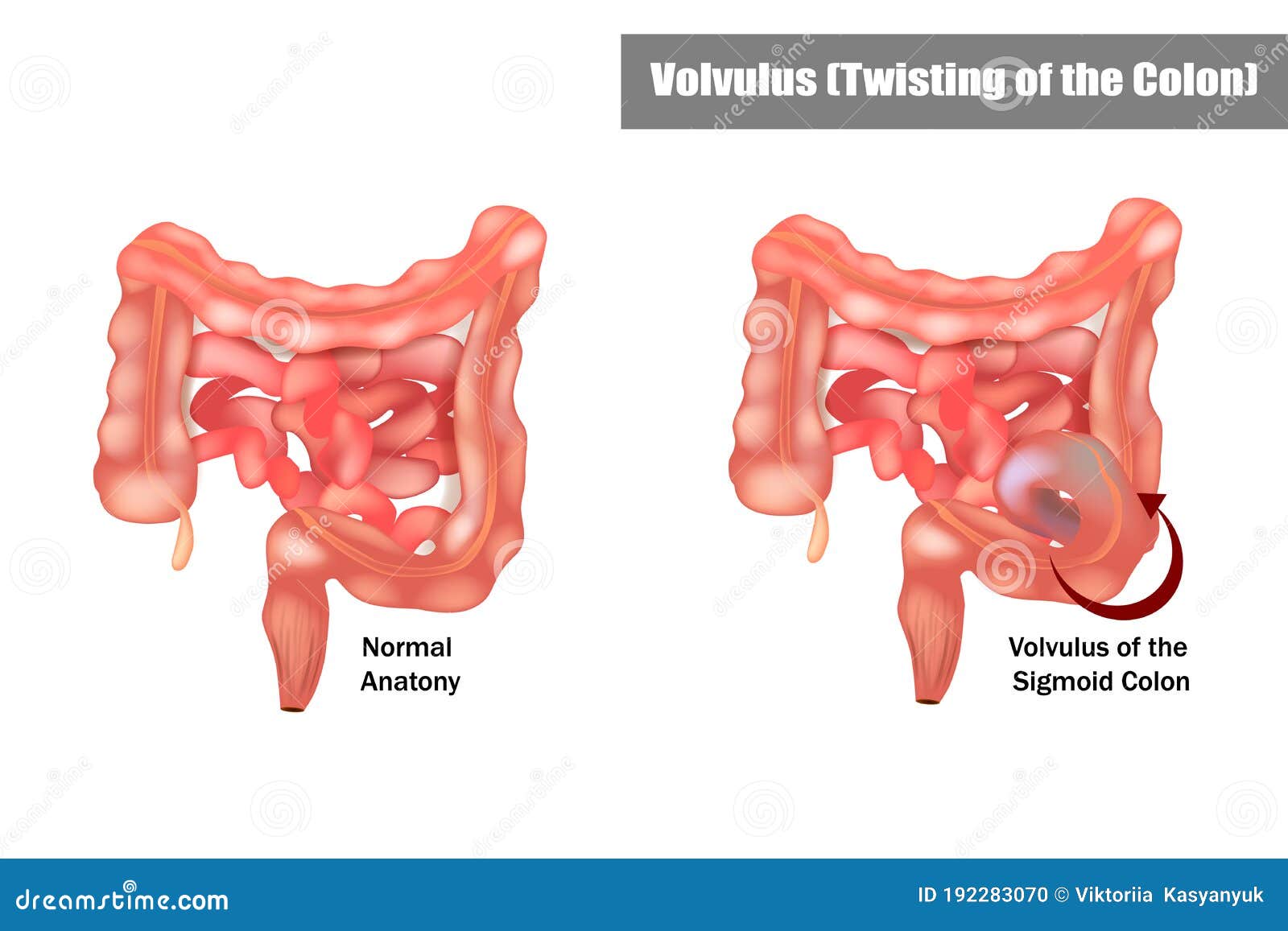 Volvulus of the Sigmoid Colon Stock Illustration Illustration of