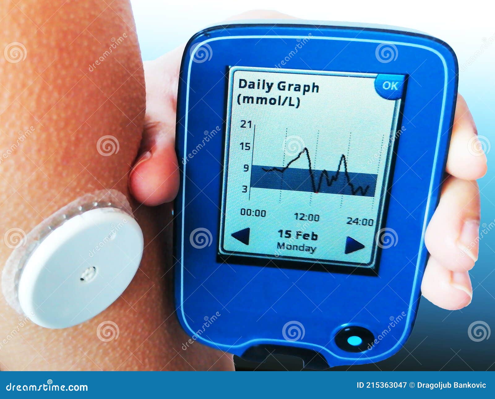 Vorrichtung Zur Kontinuierlichen Glucoseüberwachung Ndash Cgm. Weißer  Sensor am Arm. Tägliche Grafik Auf Dem Bildschirm. Stockbild - Bild von  obacht, heilung: 215363047