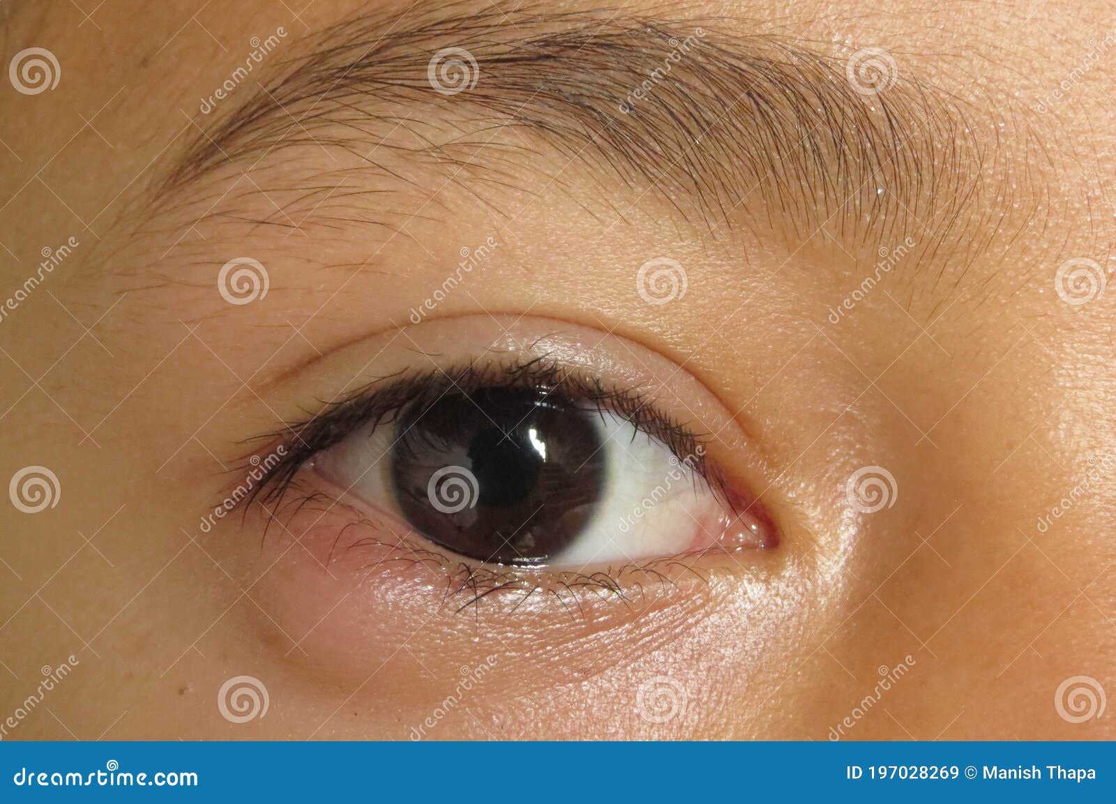 179 Chalazion Photos Libres De Droits Et Gratuites De Dreamstime