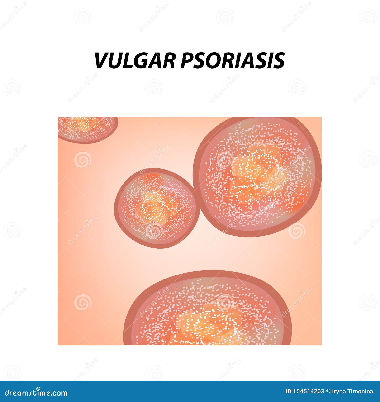 Plakkos psoriasis vulgaris fotó