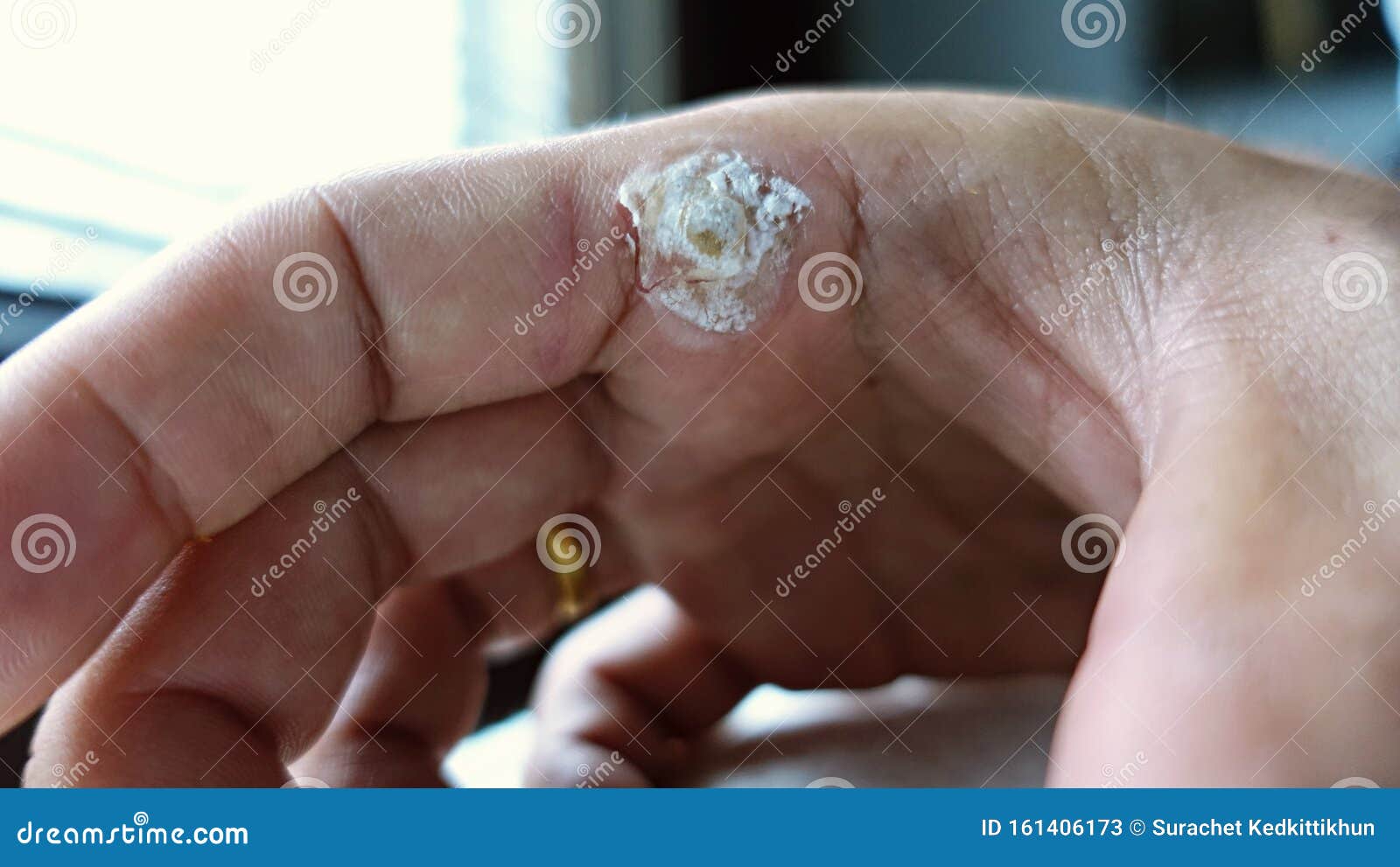 wart treatment finger