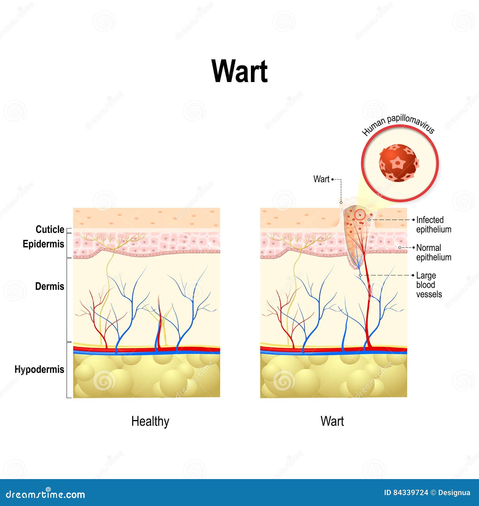 Hpv cancer and warts