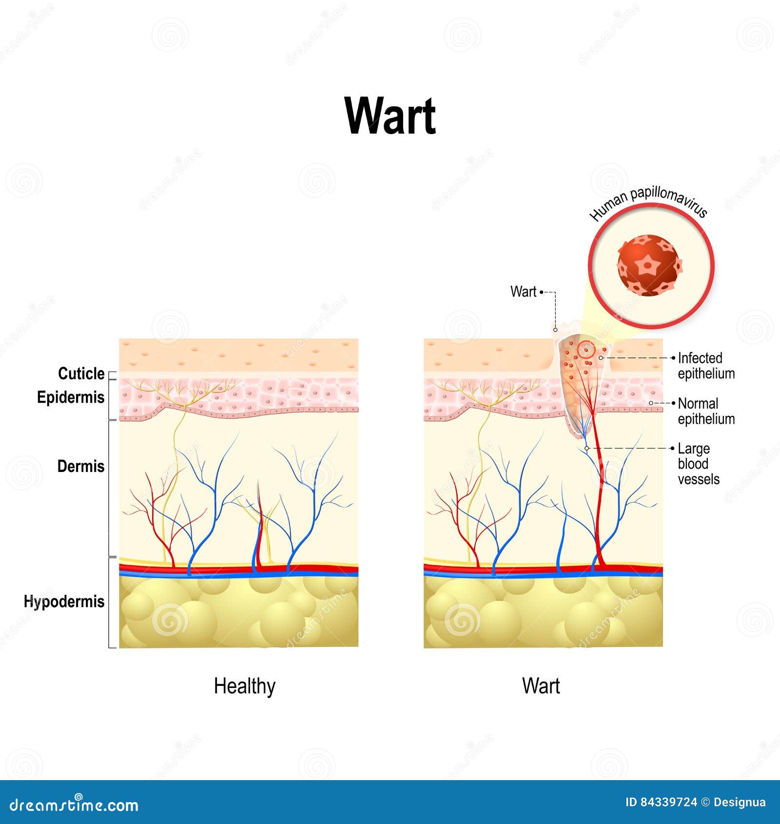 hpv cancer and warts