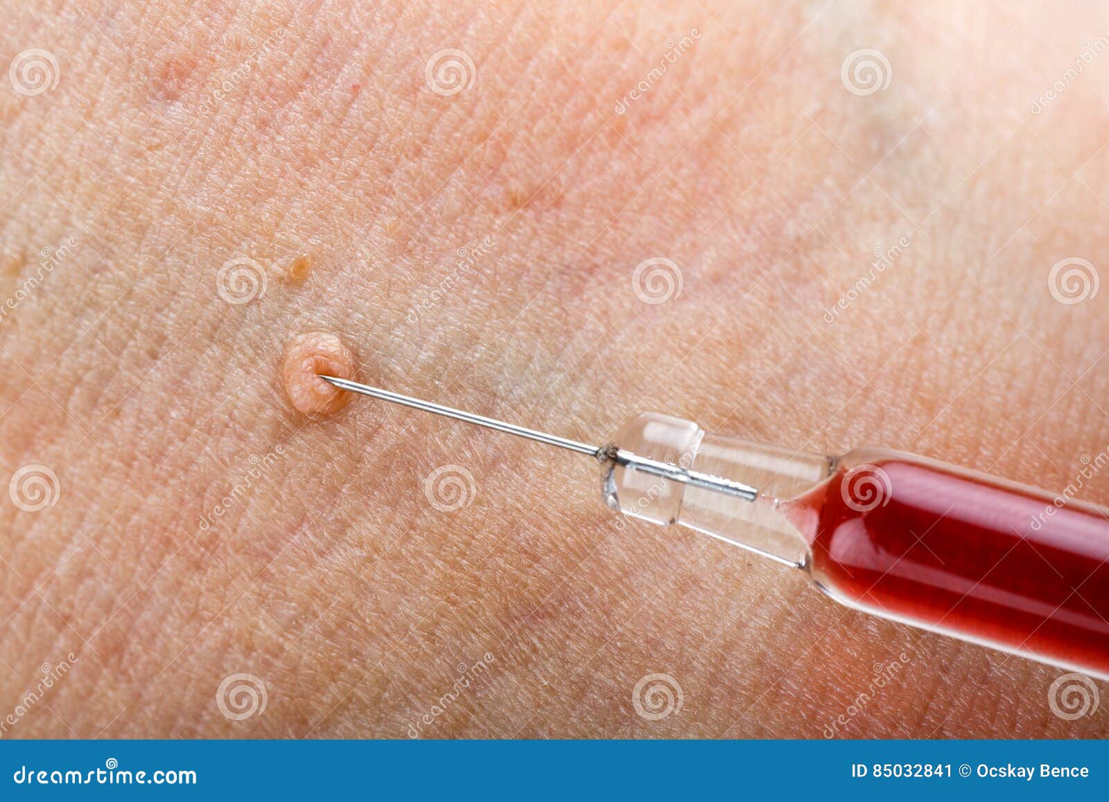 Treatment Wart On Finger By Salicylic Acid Stock Photography