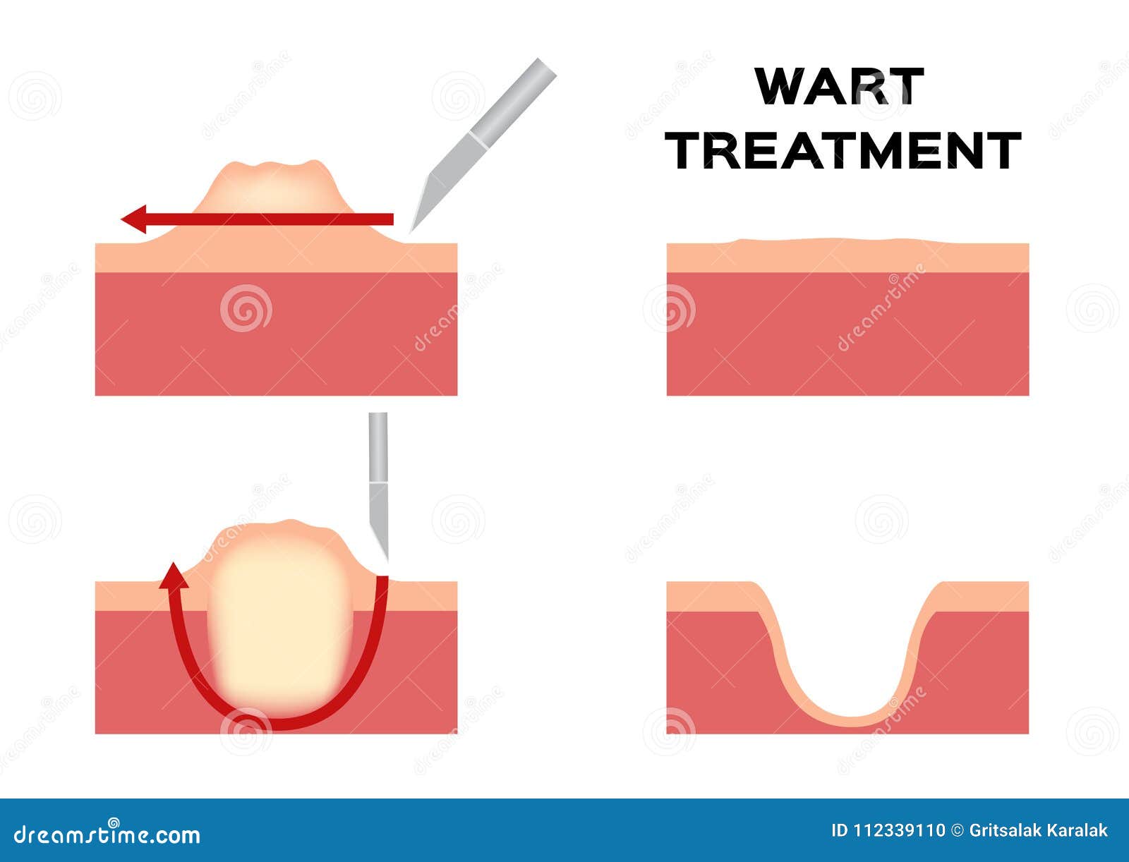 wart treatment . remove it from skin by surgery callus