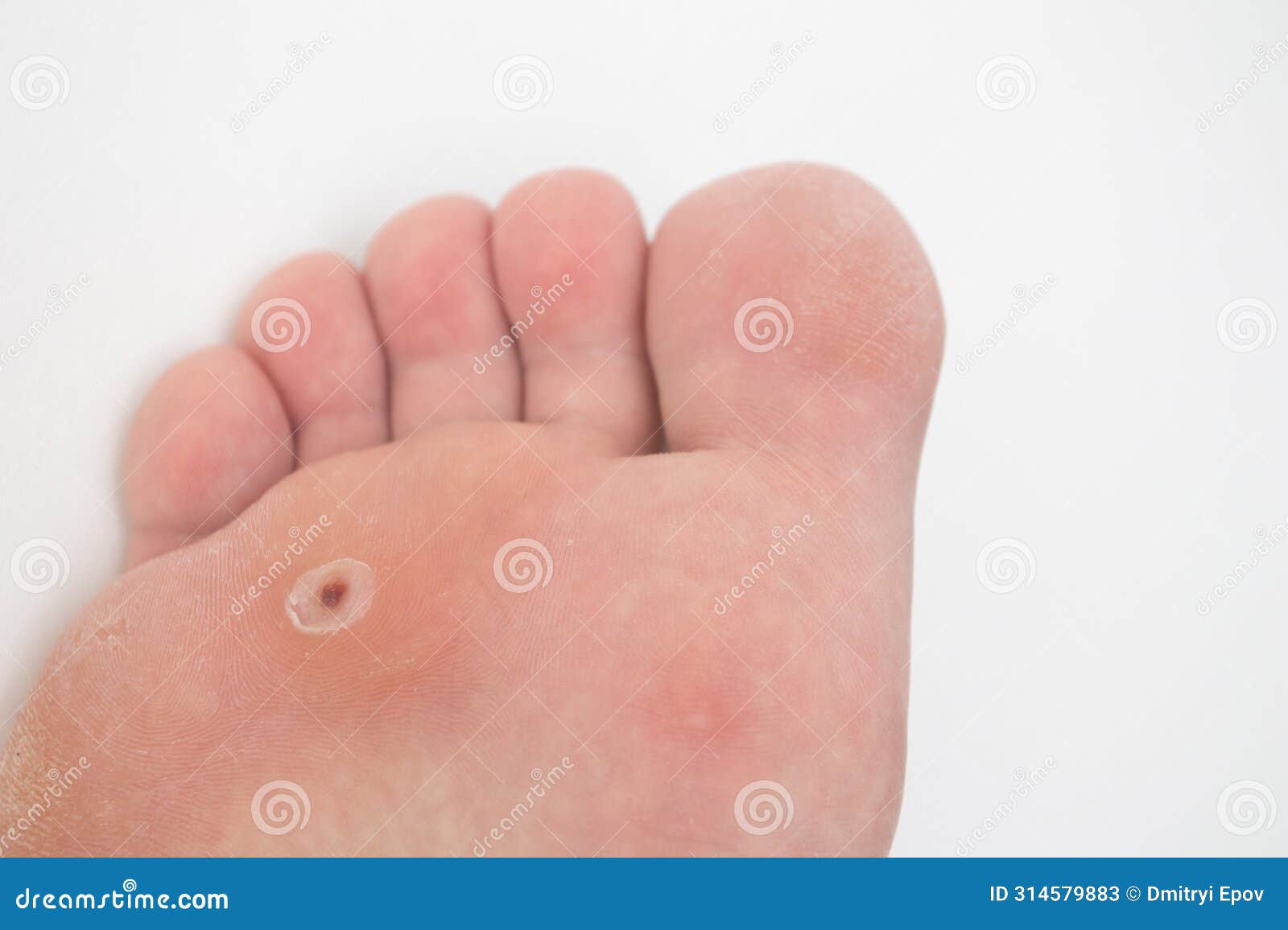 Wart Verrucas Plantar. Plantar Wart on the Foot Stock Image Image of