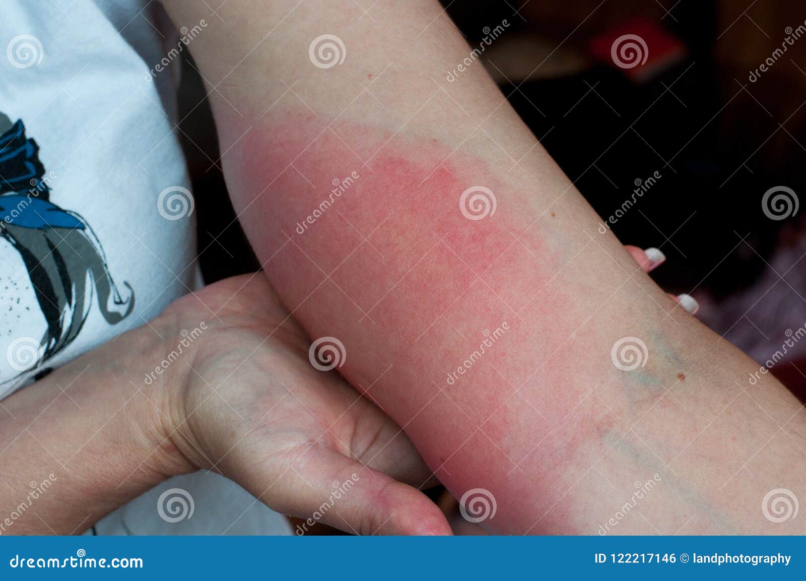 bee sting swelling bee sting swelling