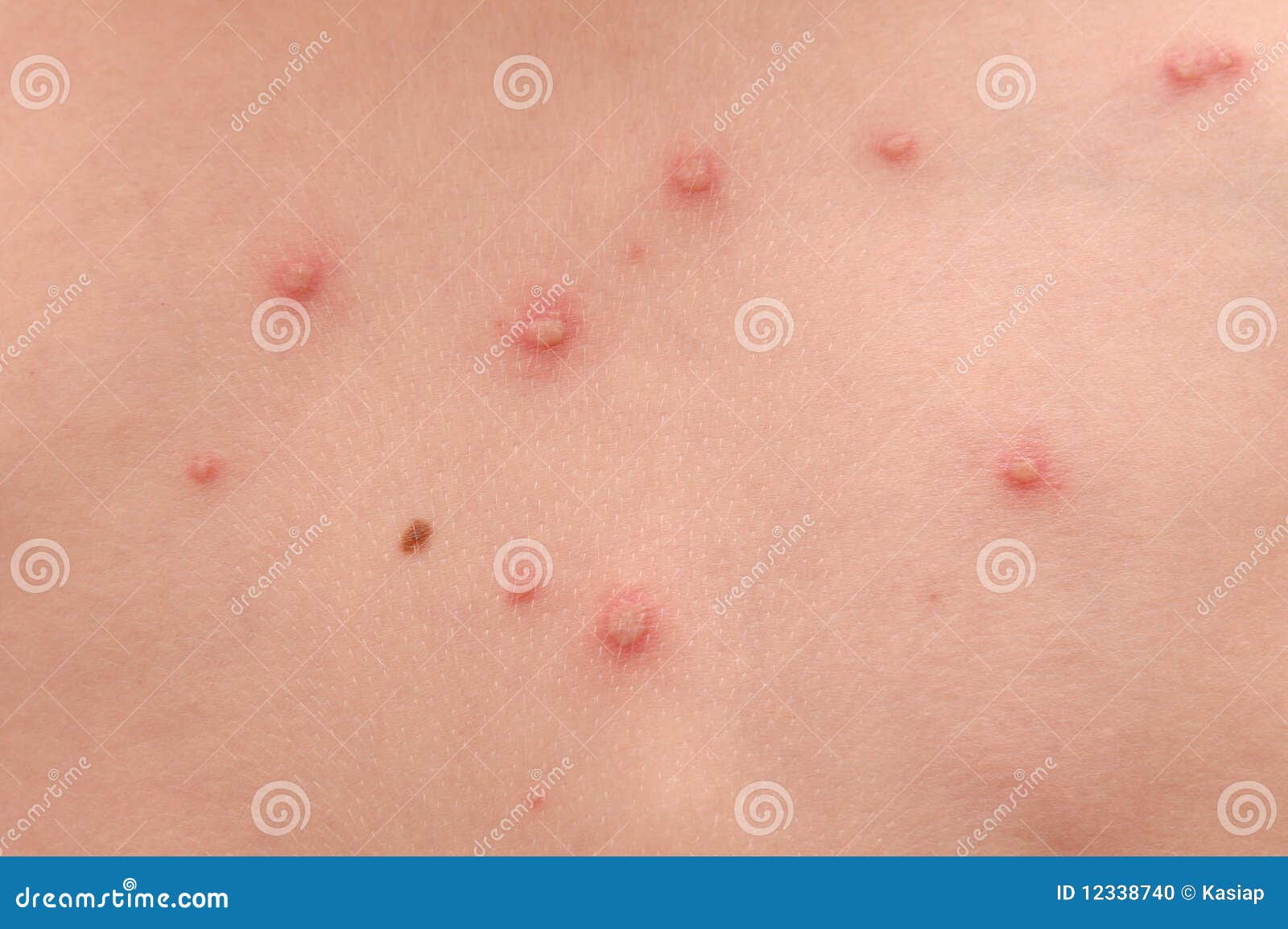 rash on your back