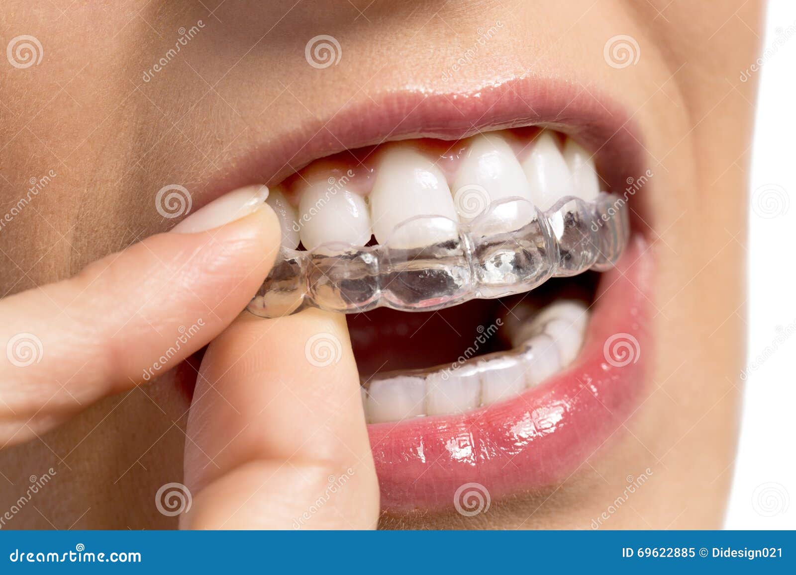 Wearing Orthodontic Silicone Trainer Stock Image Image of patient