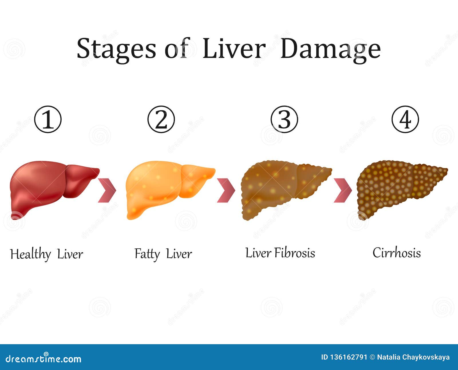 Stages of Liver Damage, Liver Disease. Healthy, Fatty, Liver Fibrosis ...