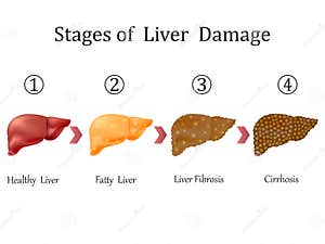 Stages Of Liver Damage Liver Disease Healthy Fatty Liver Fibrosis 