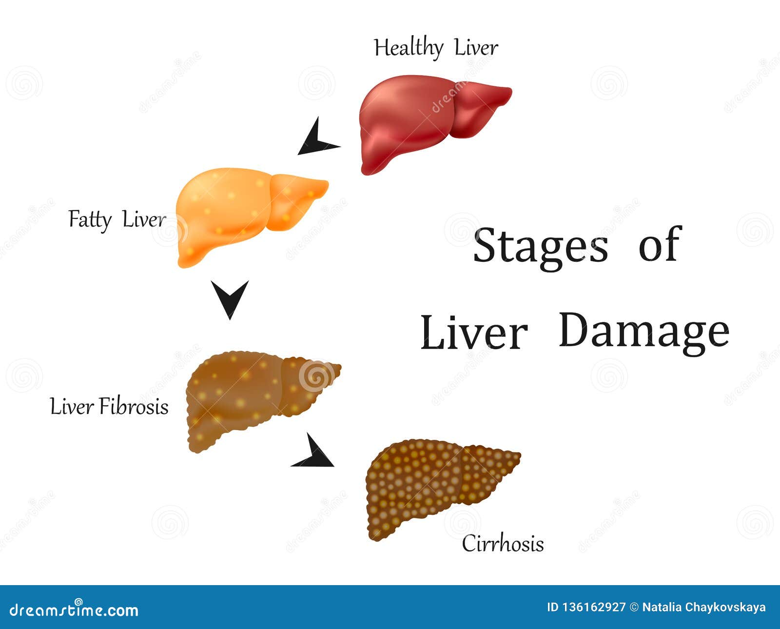 Stages Of Liver Damage Chart Poster Laminated | stickhealthcare.co.uk