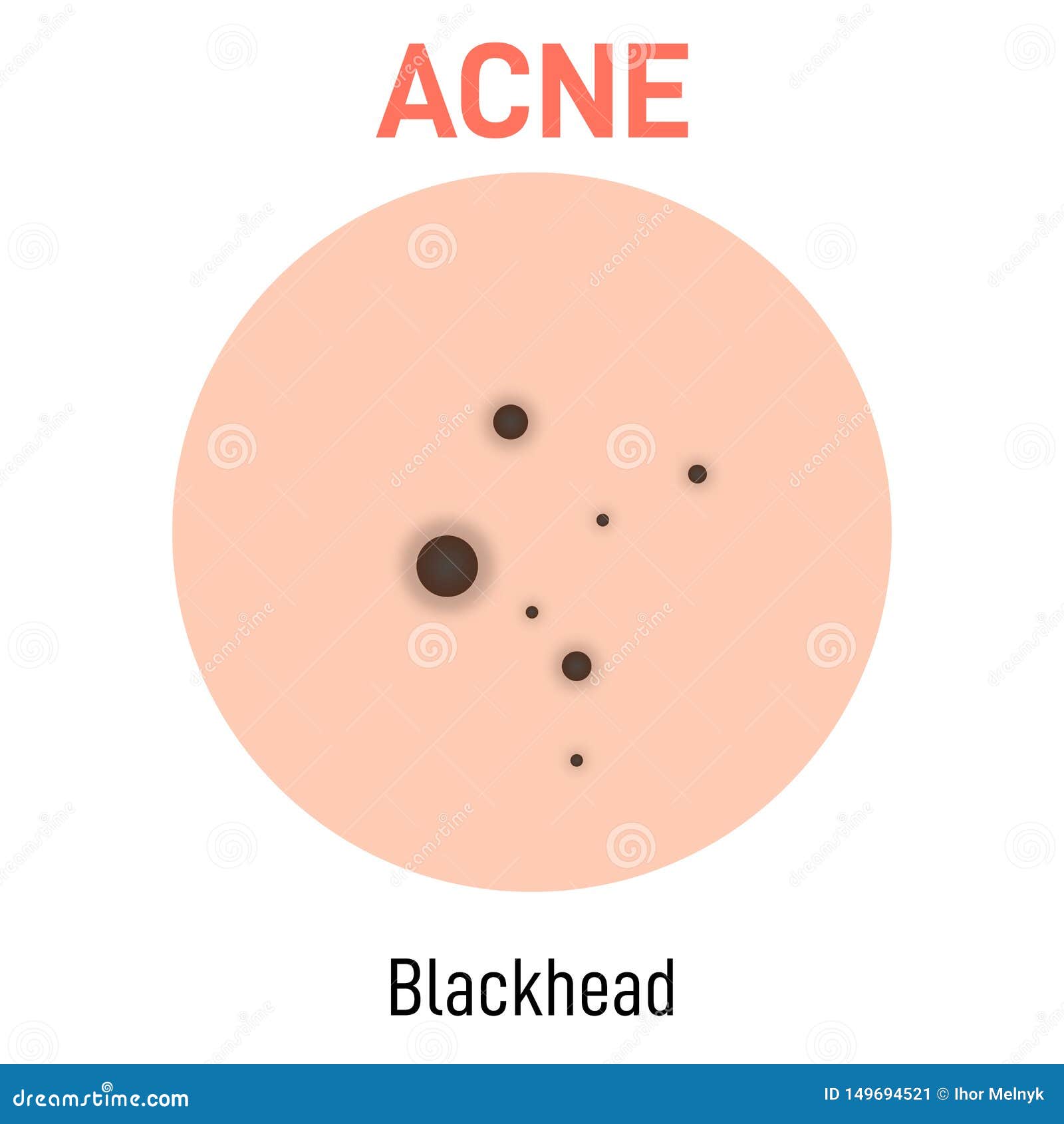 Blackhead skin acne type stock vector. Illustration of blackhead ...
