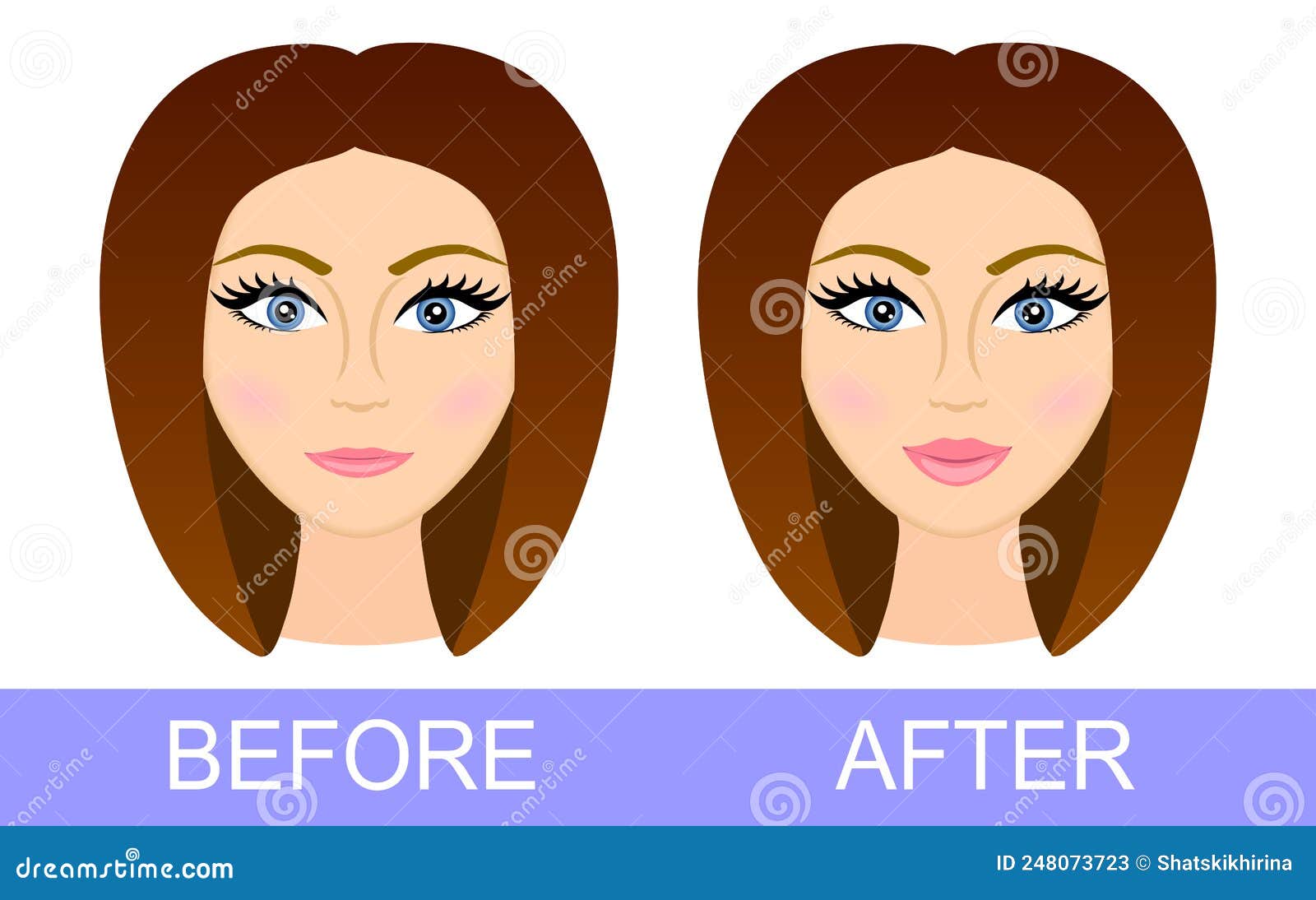 Before After Lip Correction. Woman After Using Lip Filler. Lip